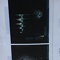 有没有二胎和一胎隔的近的，据说二胎需要提前剖腹产，而且比一胎痛。不知道是不是