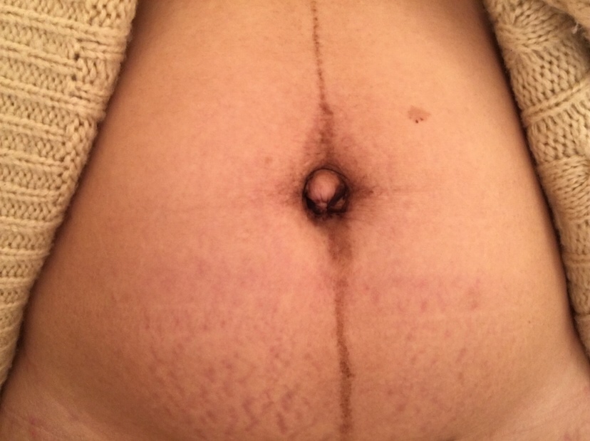 生完宝宝的肚子，丑丑的