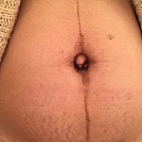 生完宝宝的肚子，丑丑的