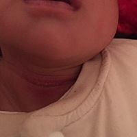 宝宝脖子和腋窝都这样红红的，好像是太热流汗或者吐奶没及时擦成这样了，心疼，有这种的宝宝没，教教我...