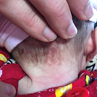 今天上医院问医生，我们家宝宝后颈部长了一片跟红疙瘩一样的东西，问了3个医生，回答的都不一样，有说是...