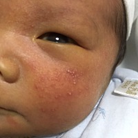 想问一下，宝宝1月3号37周羊水破剖腹产生的，现在十天了。出院后没注意，妈妈吃了一只鸽子，两天后宝宝...