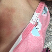 孕期得了湿疹怎么治？好难受全是一大片一大片的，太难受了晚上格外厉害，痒的不行。