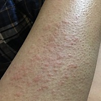 越抓越痒，哪个孕妈知道这是怎么了，手上腿上都有，越抓越多