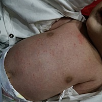 问一下一个月20天的宝宝身上这个是什么 过敏吗