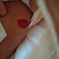 我的宝贝安妮 腰间和后脑勺有血管瘤 心都要碎了 有同样情况的吗 怎么治疗的 效果怎么样 如果有 请您联系...