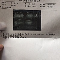 孕8+4做b超医生说孕囊大，有没有大神宝妈帮忙看看是男是女，会不会长两个胎芽变成双胞胎。