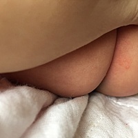 宝宝两个月了，刚刚发现屁屁长了一些小痘痘，有谁知道是什么吗？刚刚擦了点茶油不知道管不管用。