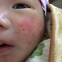 各位宝妈请问这是胎麻还是湿疹？