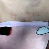 有这样的吗？ 背部和胸部上方，怀孕后长了很多这个籽，热了还很痒的。