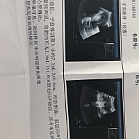 我怀孕50天了，今天做B超沒胎心和胎芽，医院让我一星期后在过来，是不是要流产呢？