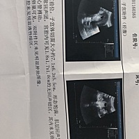 50天没胎心胎芽，谁能看懂？心里没底难受。