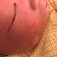 宝宝脸上长满了这个，不知道应该怎么消掉😢