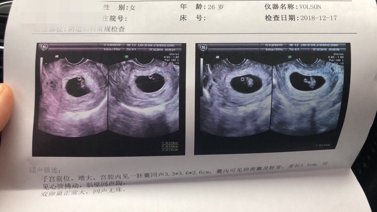 听朋友说看孕囊就可辨别男女，是这样吗？！