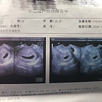 听朋友说看孕囊就可辨别男女，是这样吗？！