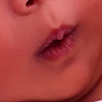 各位宝妈，拜托帮我看看，孩子鼻子上的是什么呀？是热的吗？怎么治呀？