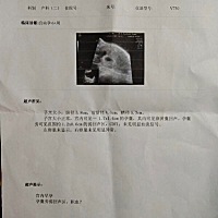 怀孕47天，去检查说胎囊边上有血，谁有没有这种情况啊？？？？？？？跪求啊！