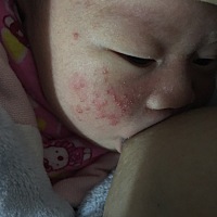 宝妈们，宝宝脸上长湿疹怎么弄？