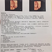 本来约在24周做四维 刚好今天去医院做无创DNA 顺便一起做了四维 很是配合一次就过了 好动的一直顶医生的...