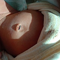 宝宝肚脐七天就掉了，今天突然发现好像有点出血，有这样同样状况的吗？这该怎么办