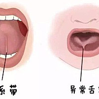 有突然发现宝宝舌系带短的吗？今天去医院检查医生居然说正常的，但是宝宝明显不正常，舌系带和其他人不...