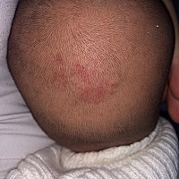 有人知道这是不是血管瘤吗？今天给宝宝理发的时候发现的。