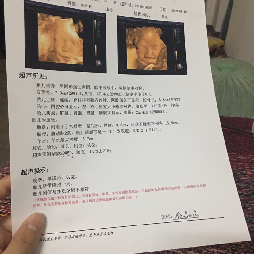 胎儿周数也不符，挤带绕颈一圈，不知道要不要紧。