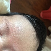 我是新手爸爸，请问宝妈们宝宝额头长的这是啥？是不是穿太多捂热了？