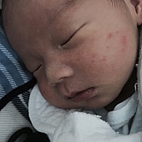 宝宝脸上长了小痘痘，据说是湿疹，怎么搞？会不会留疤啊？