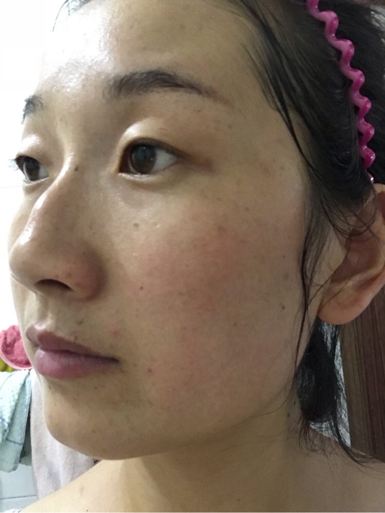 有没有宝妈怀孕后斑更多的，天天愁死我了，j