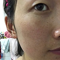 有没有宝妈怀孕后斑更多的，天天愁死我了，j