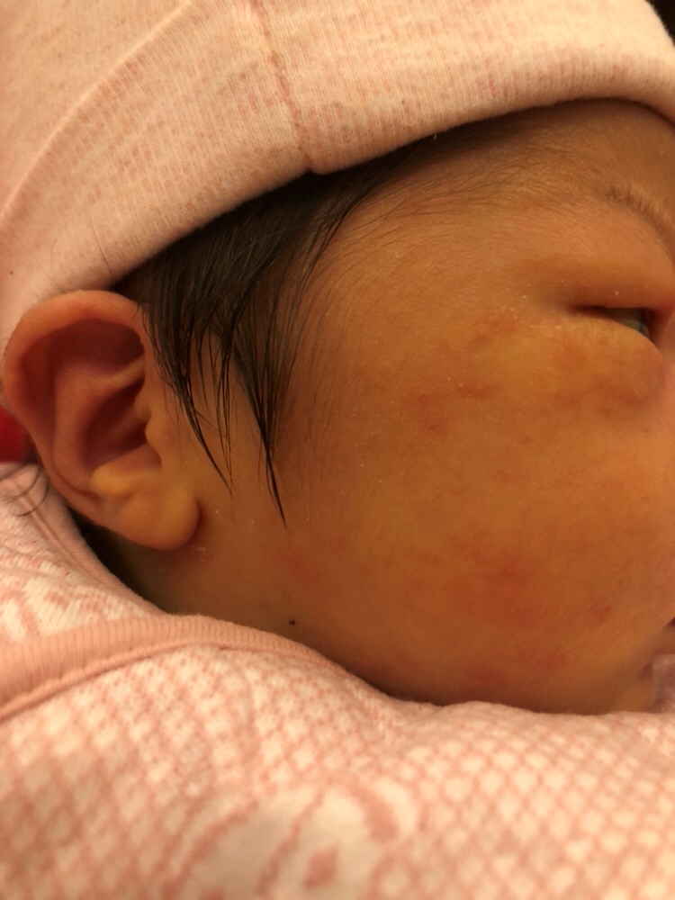 宝宝脸上长红点点，是什么哇