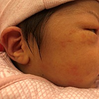 宝宝脸上长红点点，是什么哇