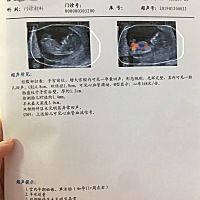今天11周+去做Nt检查，值约1.44mm。双顶径1.8cm，心率168次/分。好奇的是b超里我画了圈的整个那个就是宝...