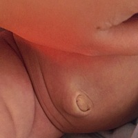 宝宝肚脐下面鼓起来，是正常的吗