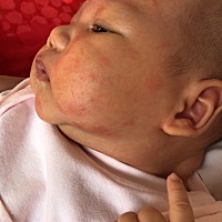 宝宝35天了，起了湿疹，满脸都是：怎么办