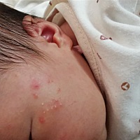 第一张图片才一点的，后面越长越多，每天都在长，看到好心痛，请问这是什么？有经验的宝妈帮看下，用什...