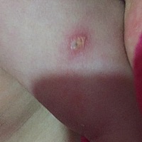 宝宝满月打完防疫针怎么是这样，有这样的吗？还是说感染了