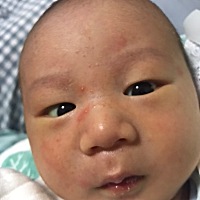 宝宝脸上这是什么？才出生18天，前两天开始突然长的，刚开始两三个，现在长了半个脸，屁股上也有！每天...