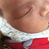 宝宝眼睛下面长了好几个小包，怎么办？有宝妈知道这是为什么长的吗