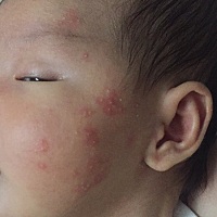 求助，宝宝脸上长了好多这样的东西，这两天头发里面也长了好多，还有后颈也有，有哪位亲知道这是怎么回...