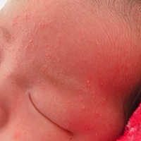 这湿疹怎么看像长的痘痘呢！一颗颗，当中还有白点，就像我上火了，长的痘痘，大家有没有怀孕期间吃辣，...