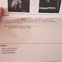 双肾分离，有没有哪位有过或者一样的，后来生了好了吗？好担心呐