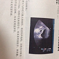 医生说情况不好，孕囊都这么大了却没见胎芽，我该怎么办