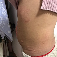 产后荨麻疹，有没有同款宝妈，有什么治疗方法吗？
