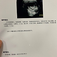 这胎心会不会太高了😭医生说孩子头大😒