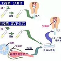 什么是试管婴儿？一张图告诉你