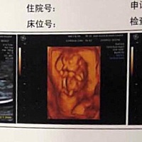 今天第一次做nt医生说一切正常。有谁看的懂的，宝宝好不好。