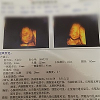 怀孕25周做四维，发现胃泡有13mm乘6mm回声，医生说很少遇到这种情况，也说不上原因，让去省级医院复查，...