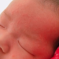 湿疹是不是用药好了，也会反反复复的？